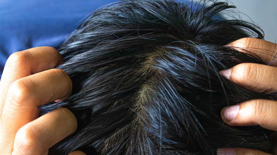 thumbnail How to Prevent Oily Hair for Men
